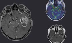 Glioblastoma hücreleri yoğun ortamda nasıl hareketleniyor?