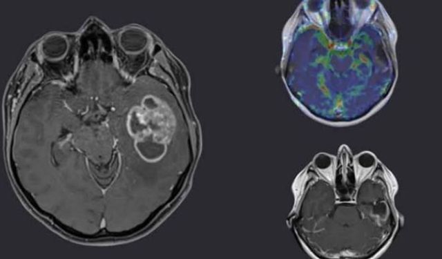 Glioblastoma hücreleri yoğun ortamda nasıl hareketleniyor?
