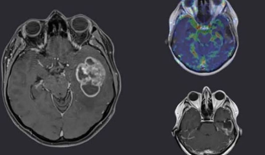 Glioblastoma hücreleri yoğun ortamda nasıl hareketleniyor?